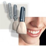 zobu implants